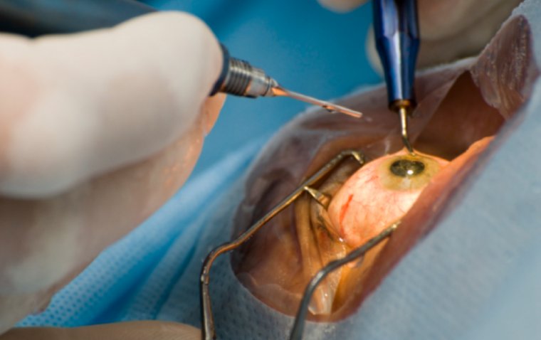 Cataract Surgery