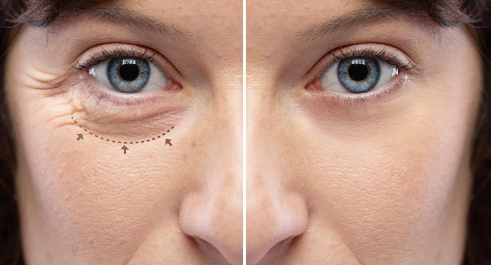 Oculoplasty Surgery