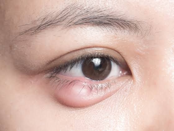 Oculoplasty Surgery